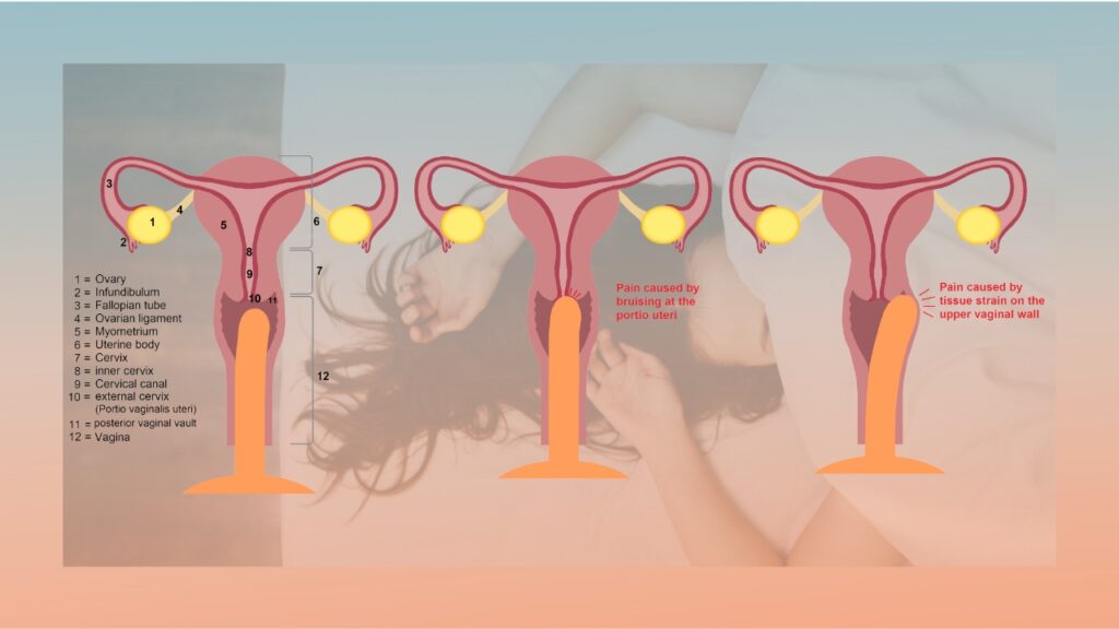 Pelvic floor muscles and pain points during intercourse